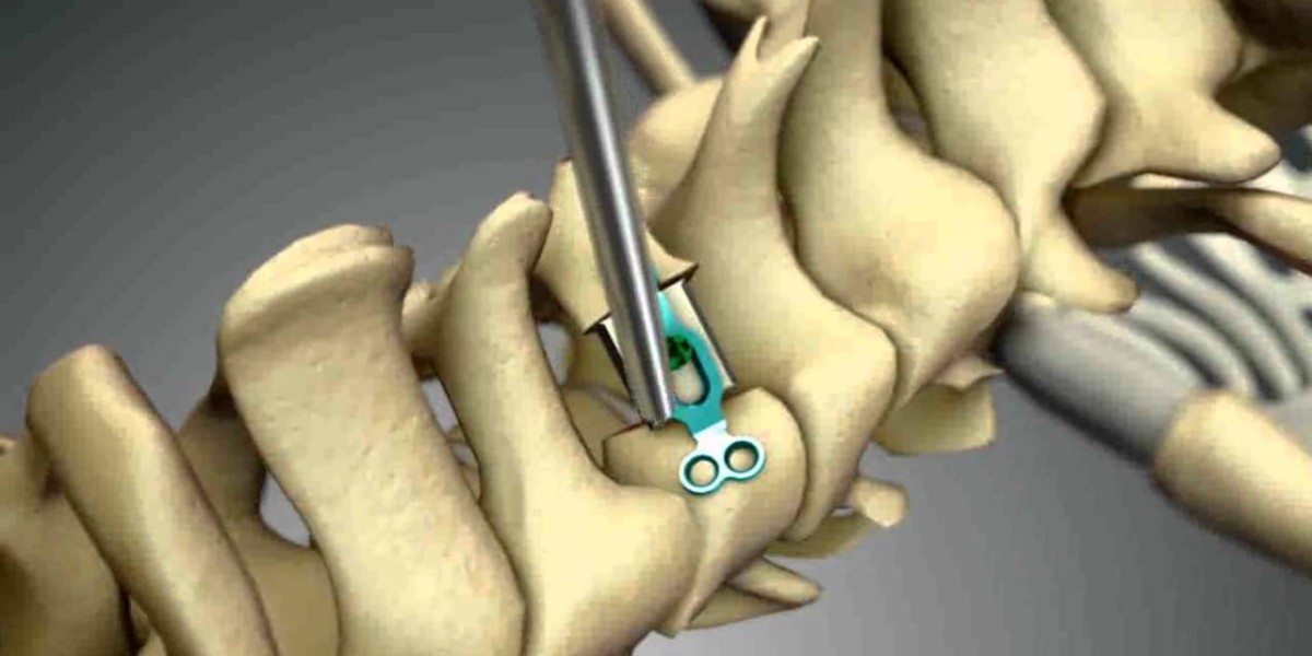 Global Spinal Laminoplasty: An Emerging Promising Procedure