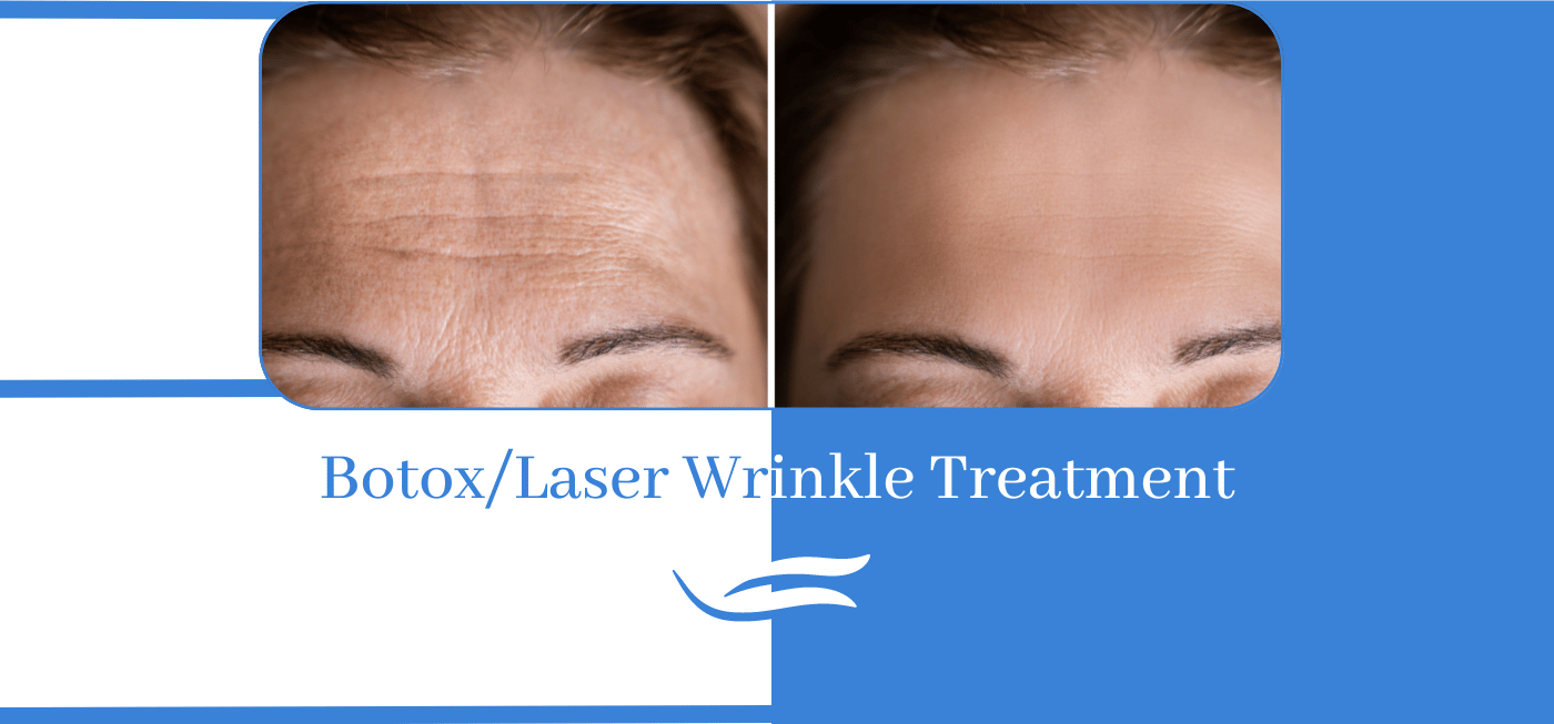 Botox/Laser Wrinkle Treatment in Bareilly - SkinCity Bareilly