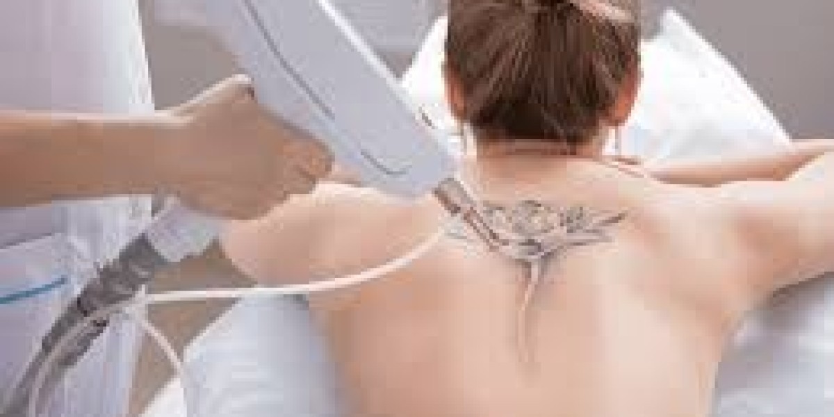 Vanishing Ink The Evolution and Efficacy of Laser Tattoo Removal