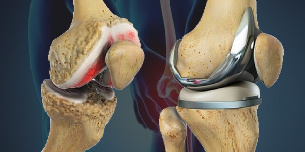 Top Knee Replacement Surgeon in Delhi: Excellence in Orthopedic Care