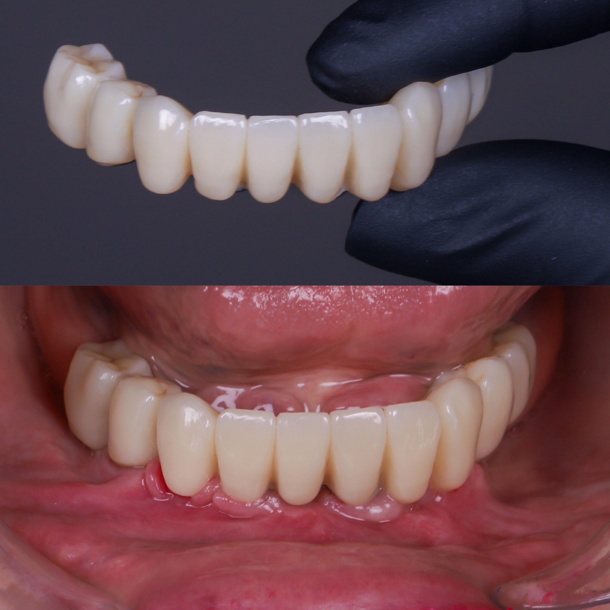 Dentadura fija sobre 4 implantes: precio, opiniones y proceso