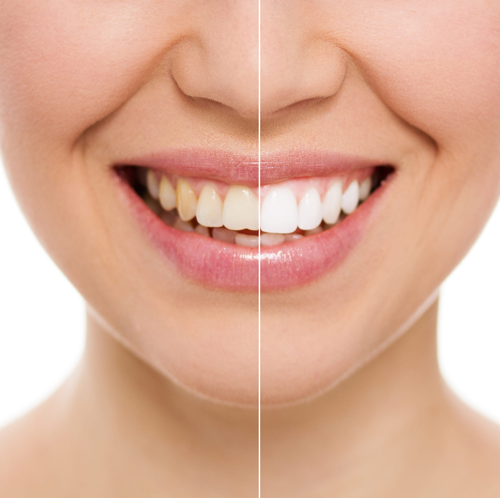 Achieve a Dazzling Smile with Crest Whitening Strips