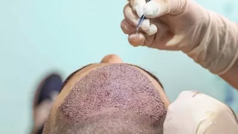 Hair Transplant Surgery in Dubai: Best Clinics and Pricing Explained | NYC Newsly