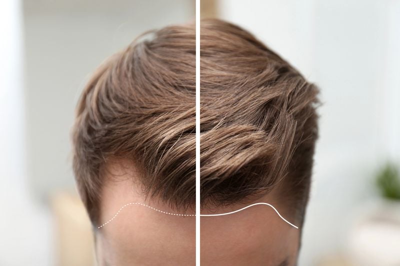 Hair Transplantation in Dubai Cost Guide: Packages, Clinics & Results - Biz DirectoryHub