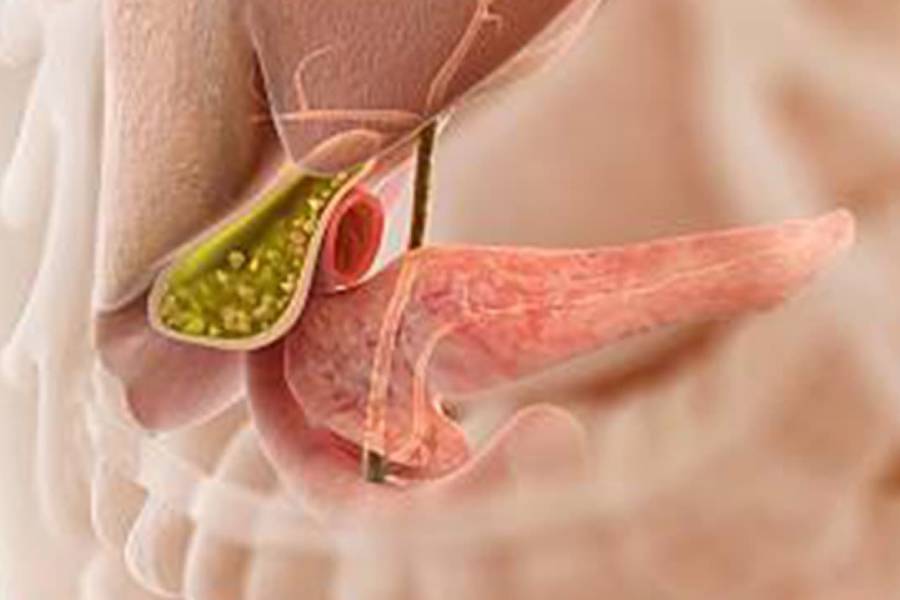 Gallstones Specialist | Gallstones Treatment in Pune- Kaizen Gastro Care